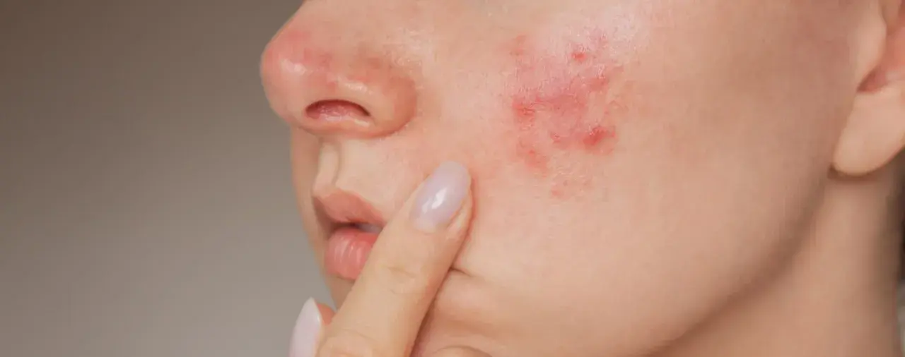Gros plan sur une joue avec un bouton d'eczéma rouge et irrité, une personne touche délicatement la zone affectée.