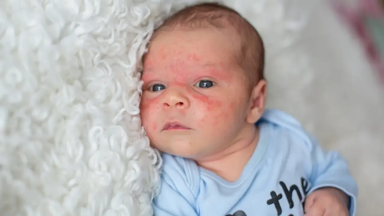 Visage de bébé avec un bouton de lait, sur une couverture blanche et moelleuse.