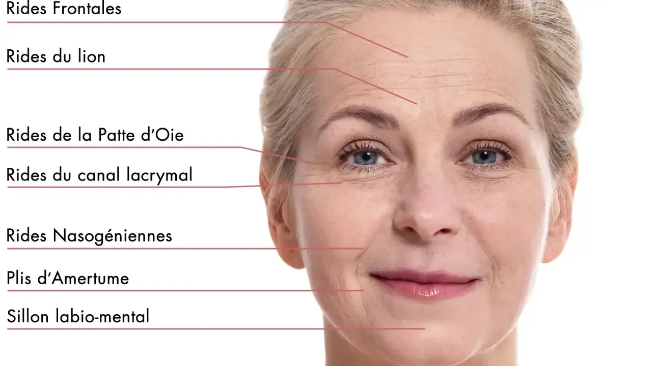 Visage d'une femme montrant les rides du visage signification : frontales, du lion, patte d'oie, canal lacrymal, nasogéniennes, plis d'amertume, sillon labio-mental.