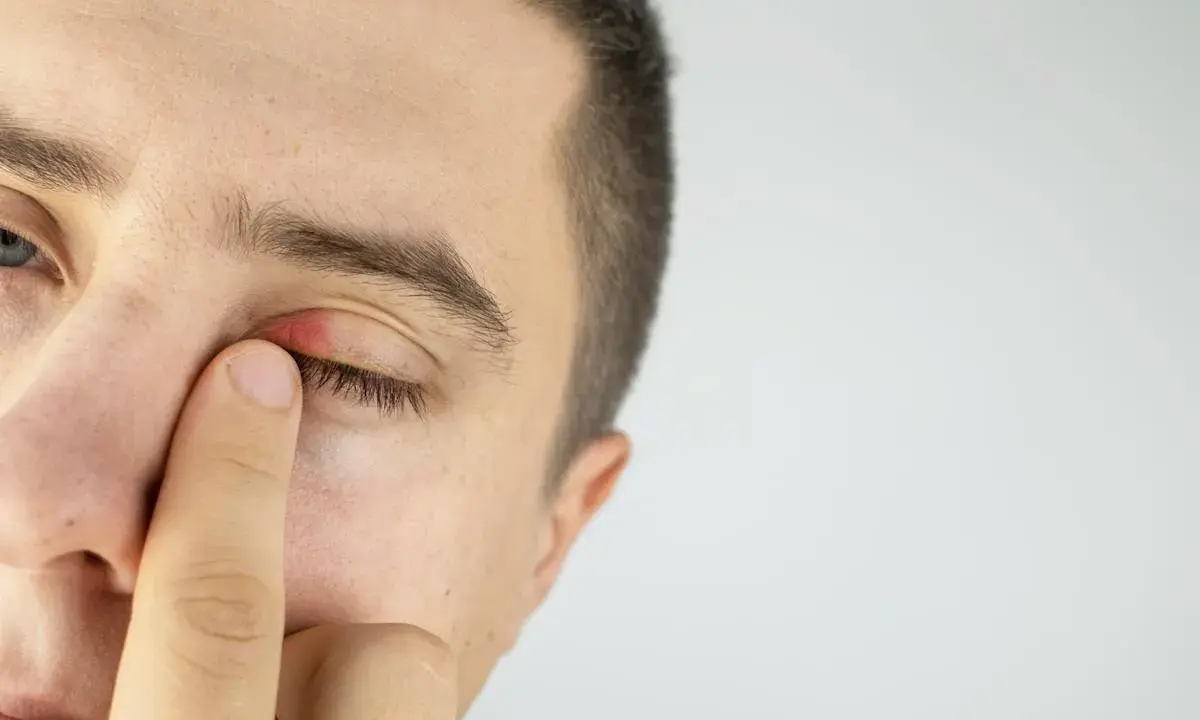 Un homme touche son œil, dont les paupières rouges montrent un orgelet.