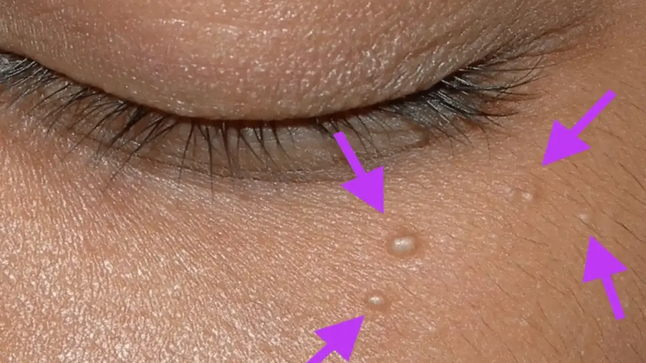Gros plan sur la peau près de l'œil, montrant plusieurs petits points blancs, des grains de milium percer, indiqués par des flèches violettes.