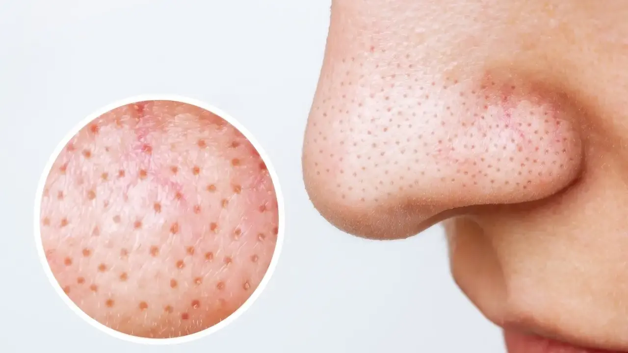 Gros plan sur le nez montrant des filaments sébacés dans les pores. Une loupe révèle la texture de la peau, suggérant des remèdes maison pour les imperfections.