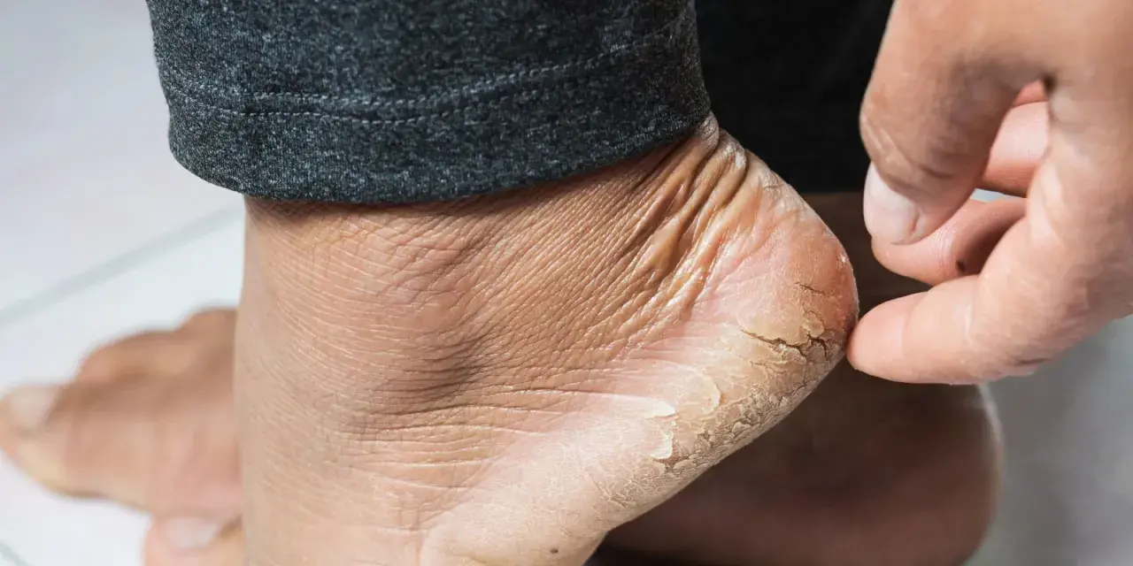Gros plan sur un talon sec et craquelé, signe de xérose pied. La peau est rugueuse et des lambeaux se détachent.