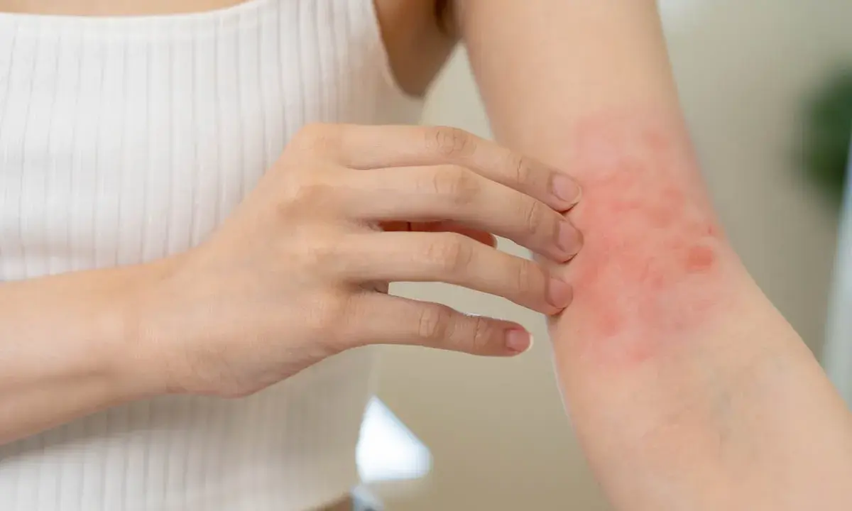 Une personne se gratte le bras, révélant un petit bouton sur les bras allergie, rouge et irrité.