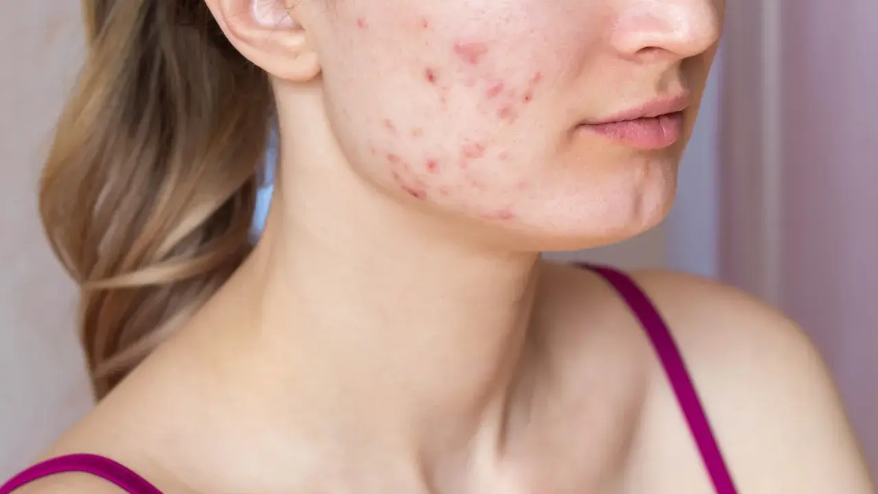 Visage d'une jeune femme montrant des rougeurs et des boutons, signes d'acné inflammatoire.