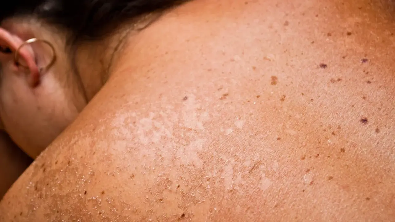 Gros plan sur une épaule et un cou montrant une peau bronzée avec des taches brunes et des zones de peau qui pèle, signe d'un coup de soleil.