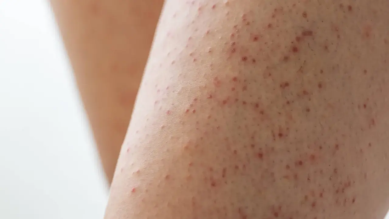 Gros plan sur une peau présentant de petites rougeurs et aspérités, signe d'un excès de kératine peau.