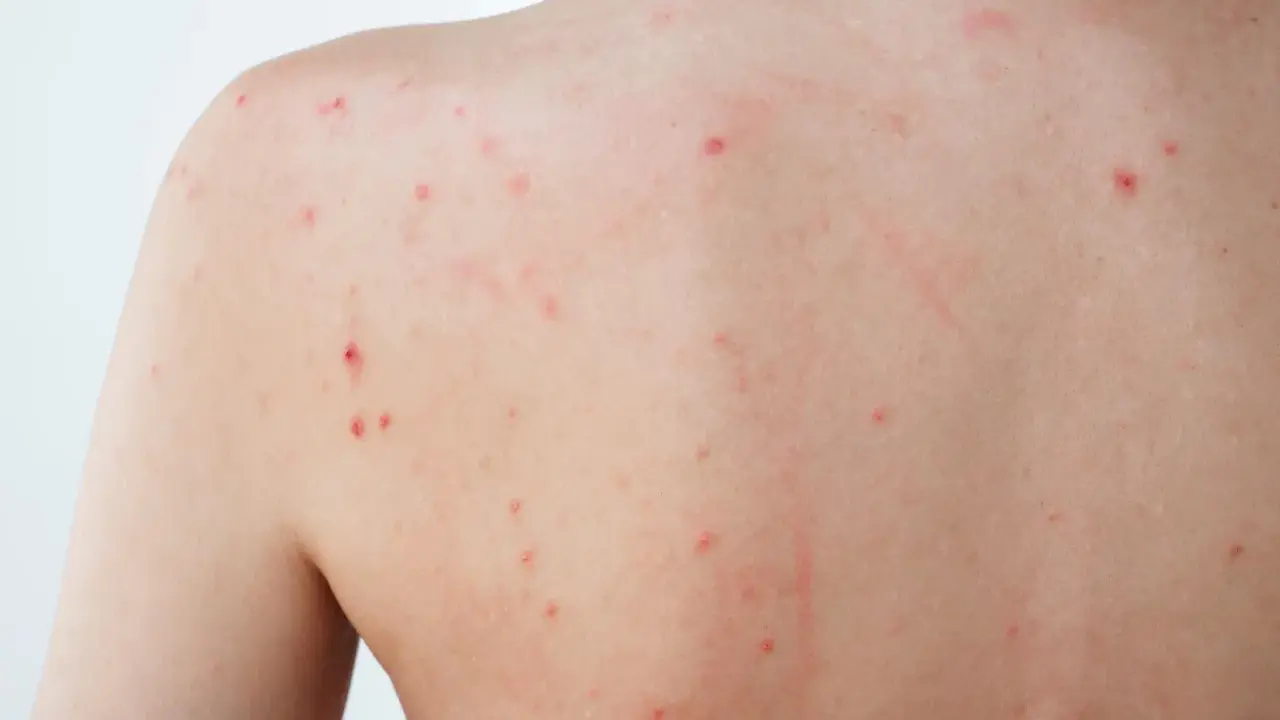 Éruption cutanée sur le dos, avec de nombreux petits points rouges, certains semblant être un bouton inflammatoire douloureux.