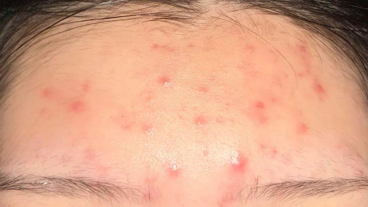 Plusieurs petits boutons rouges parsèment le front, sous la ligne des cheveux.