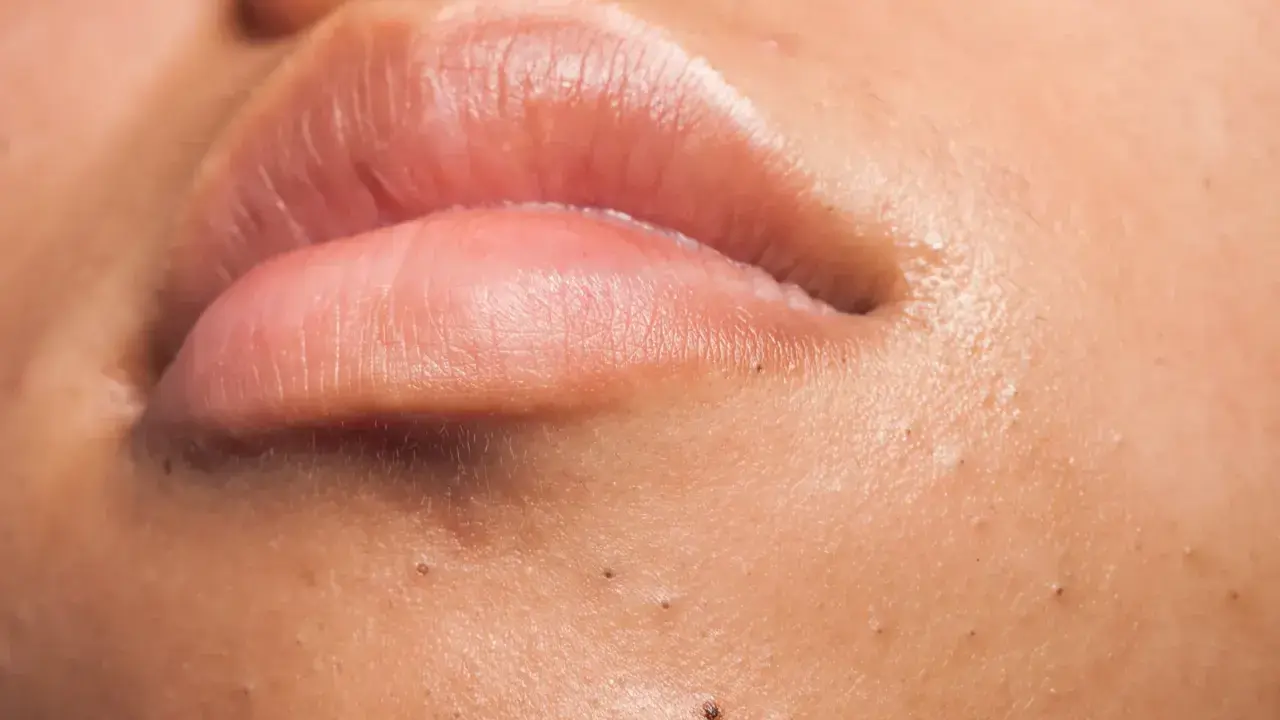 Gros plan sur des lèvres roses et une peau présentant plusieurs points noirs, ces petites imperfections qui peuvent apparaître sur le visage.