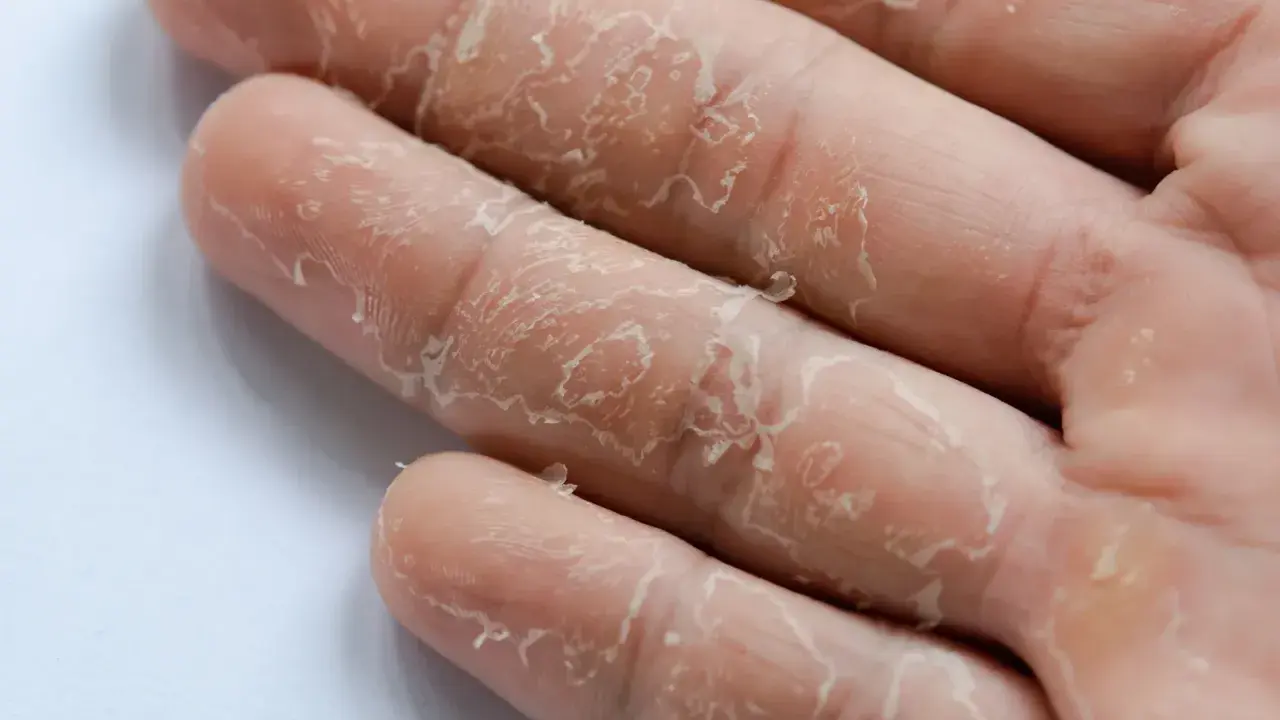 Gros plan sur des doigts dont la peau pèle sans raison, révélant une texture sèche et squameuse.