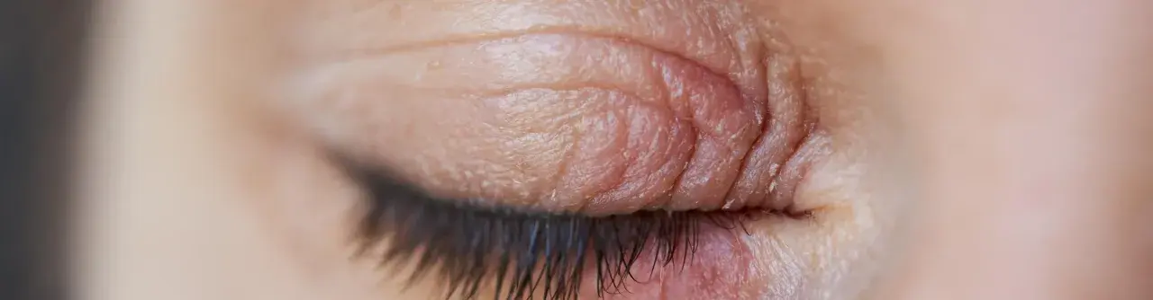 Gros plan sur un œil fermé, montrant des paupières sèches et irritées avec des ridules et des squames.