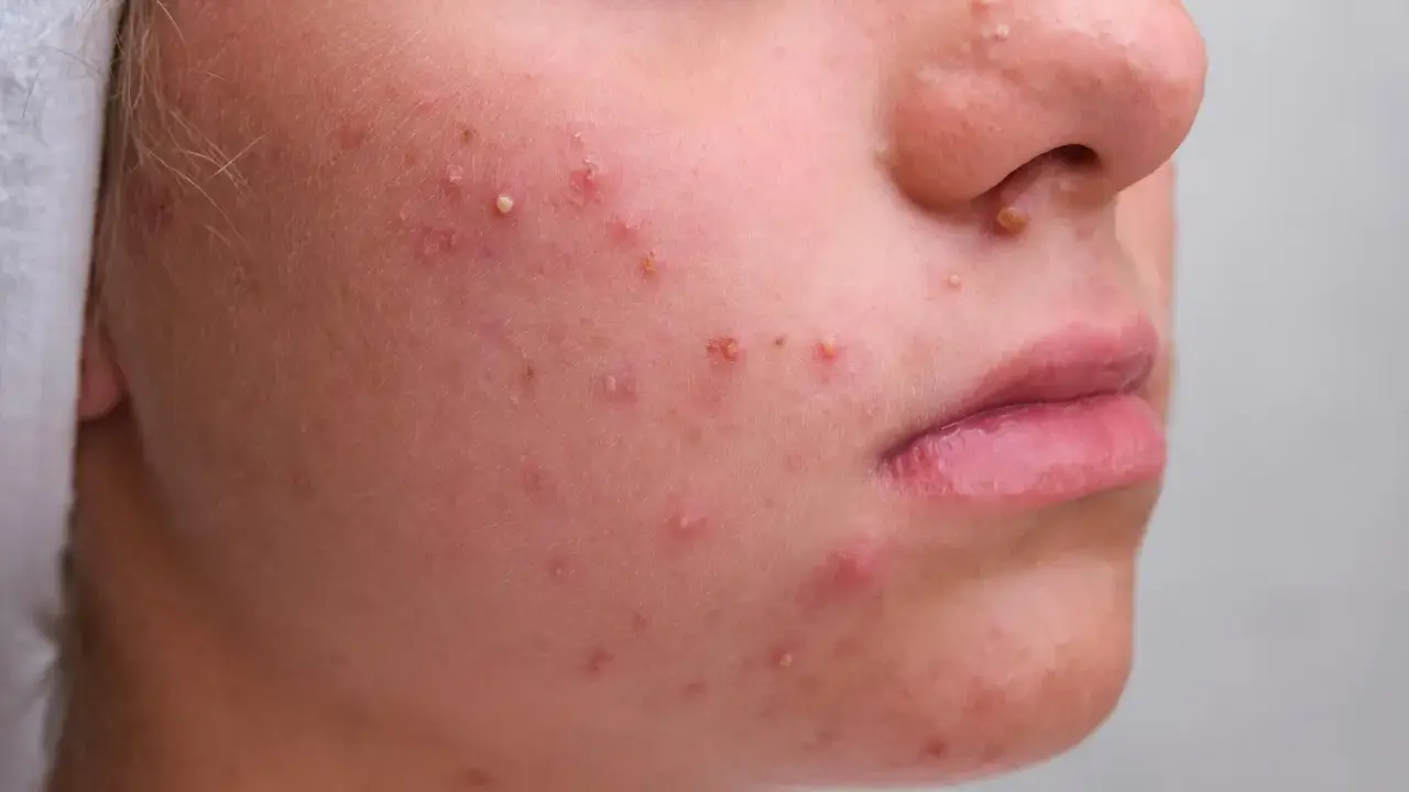 Gros plan sur un visage avec de nombreux boutons blancs et rouges, signe d'une peau à problèmes.
