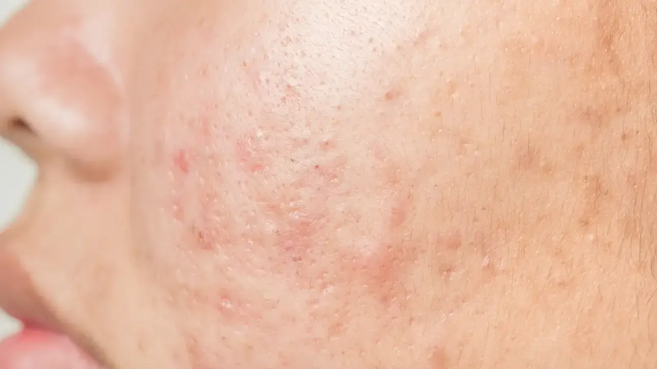 Gros plan sur la peau d'un adulte présentant des rougeurs et des marques, typiques d'un bouton visage adulte.