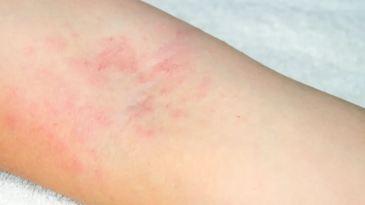 Début d'eczéma sur le bras, avec des plaques rouges et irritées sur la peau claire.