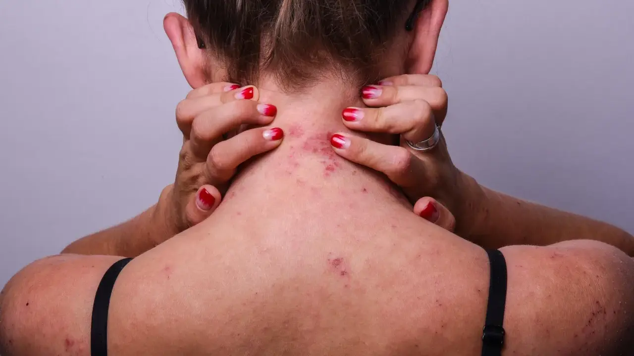 Une personne se gratte le cou et l'épaule, révélant des rougeurs et des irritations dues à l'eczéma.