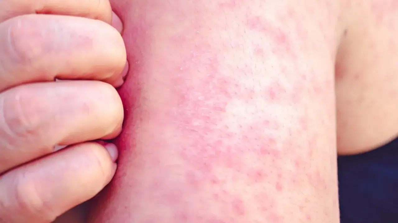 Une peau rougie et irritée, recouverte de petits boutons de chaleur, est grattée par des doigts.