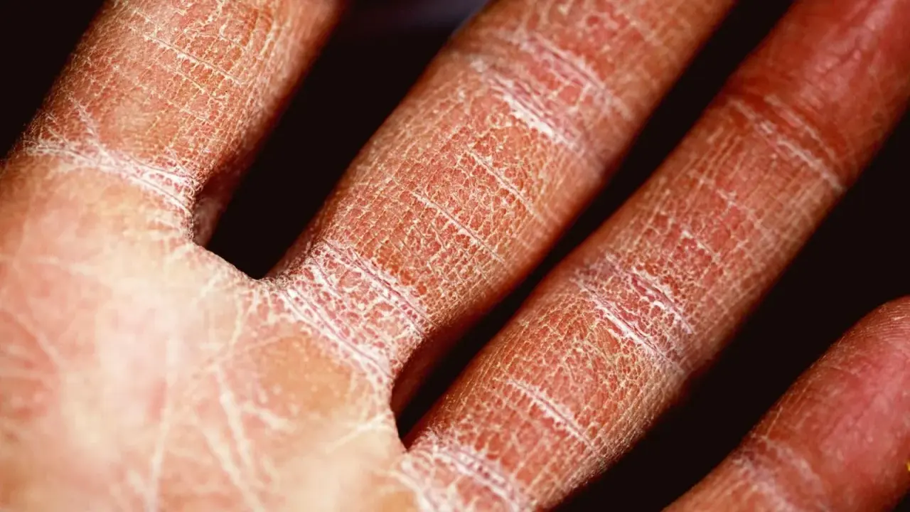 Main sévèrement atteinte par l'eczéma, la peau est rouge, sèche et craquelée, formant un réseau de fines lignes blanches.