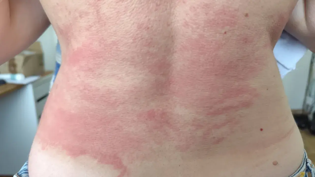 Le dos présente des plaques rouges et irritées, typiques d'un **eczéma peau**. La zone affectée est étendue, allant du cou jusqu'à la taille.
