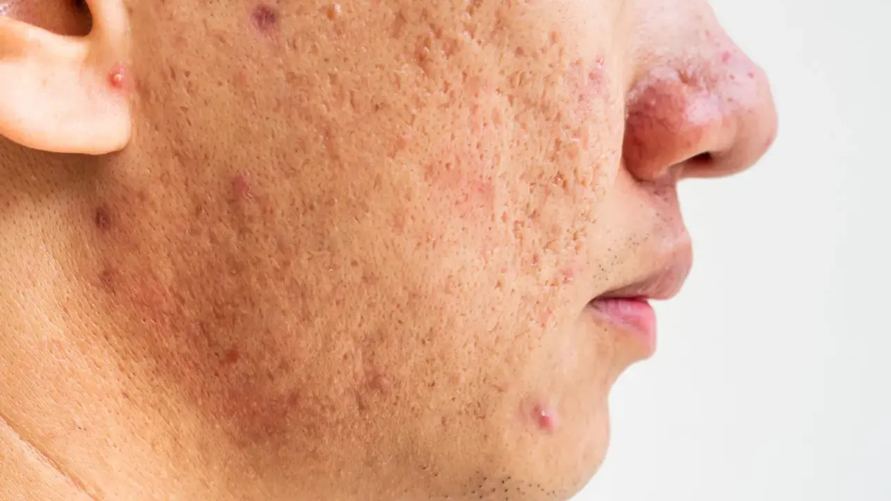 Gros plan sur le visage d'une personne montrant des cicatrices et des rougeurs dues à une acné sévère.