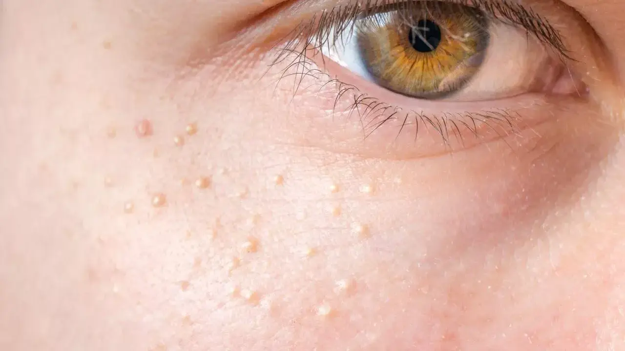 Gros plan sur la peau d'un œil, parsemée de petits points blancs, des grains de milium, qui ressemblent à de minuscules perles incrustées.