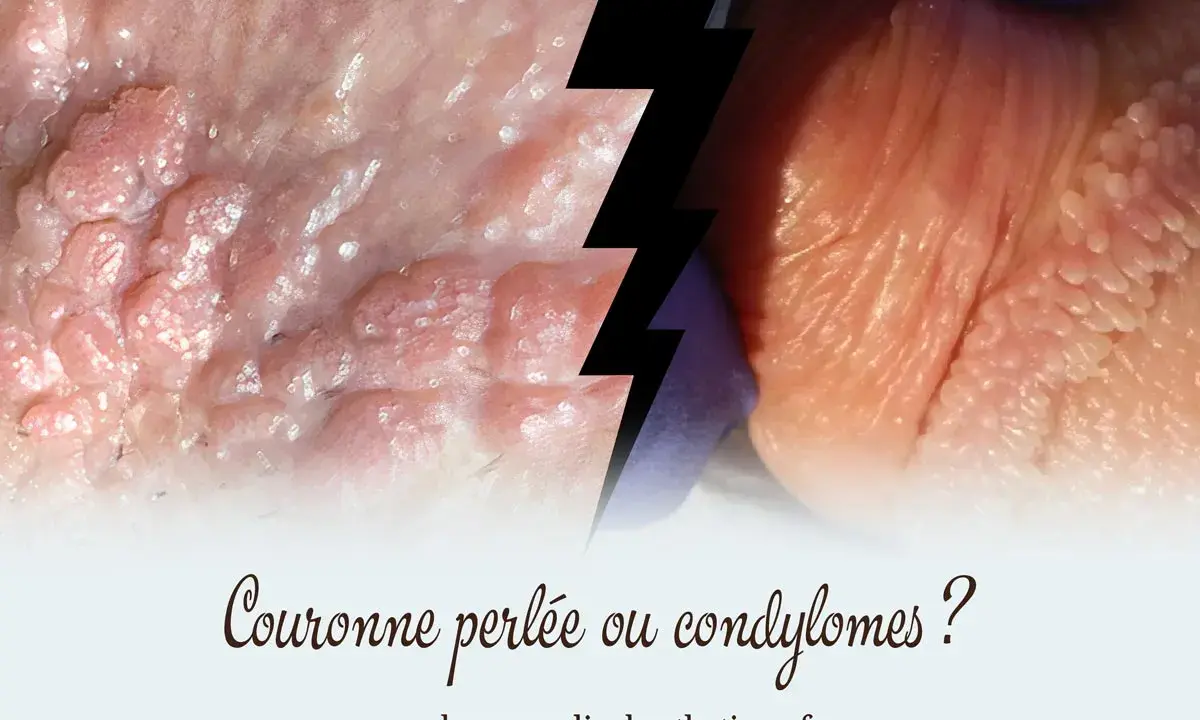 Gros plan sur des papules perlées et des condylomes, deux affections cutanées distinctes.