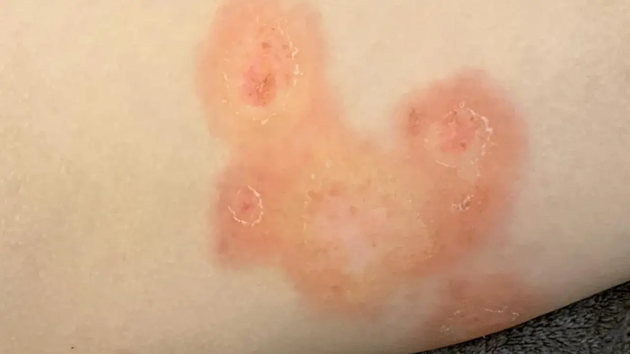 Plaques rouges et squameuses sur la peau, évoquant une mycose fessier adulte.