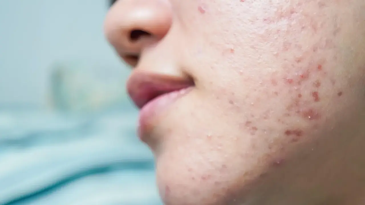 Gros plan sur une peau acnéique, montrant des rougeurs et des imperfections. Ce type d'acné peut être lié à l'effet de la progestérone sur la peau.