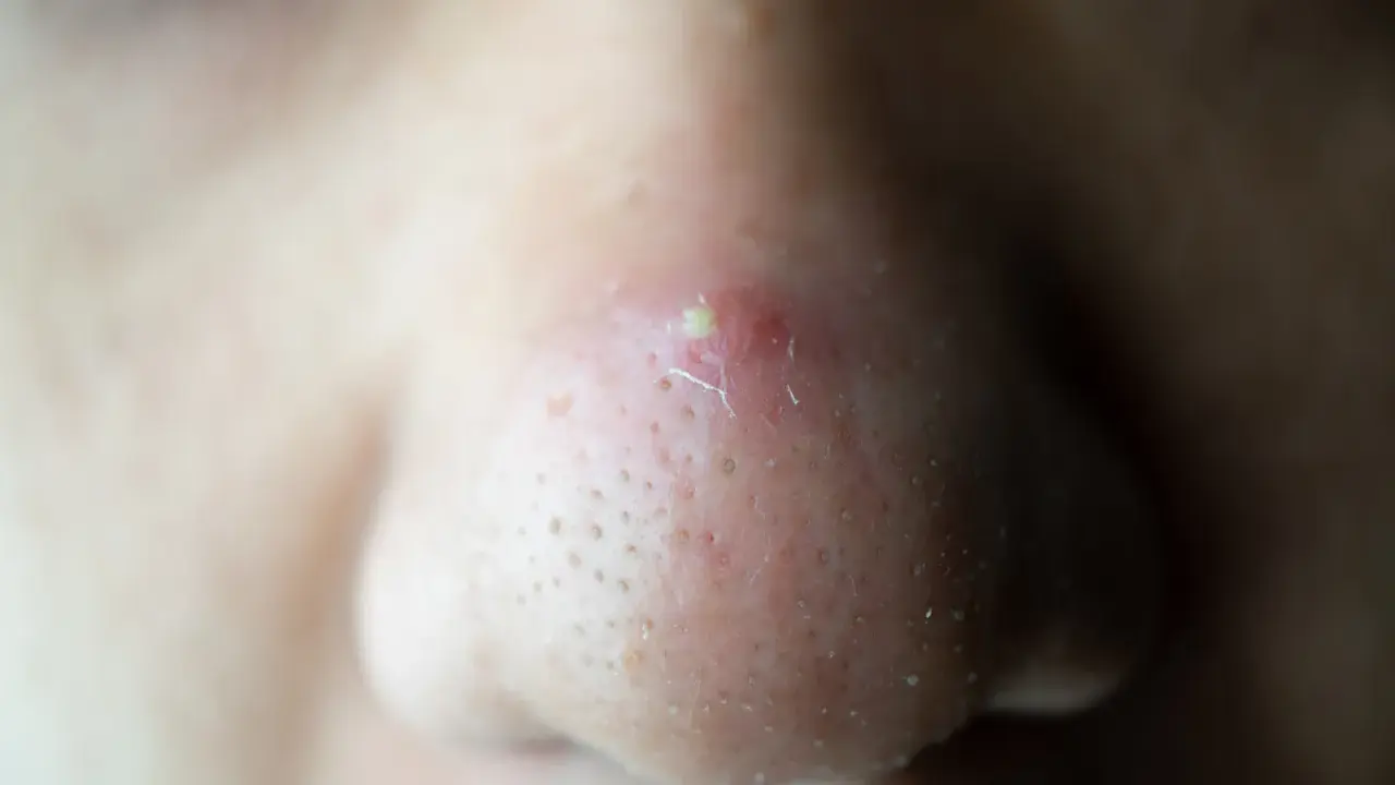 Gros plan sur un nez avec un point noir douloureux et enflammé, entouré de pores visibles.