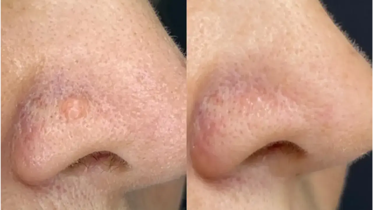 Comparaison avant/après traitement d'une papule fibreuse du nez. La lésion a disparu.