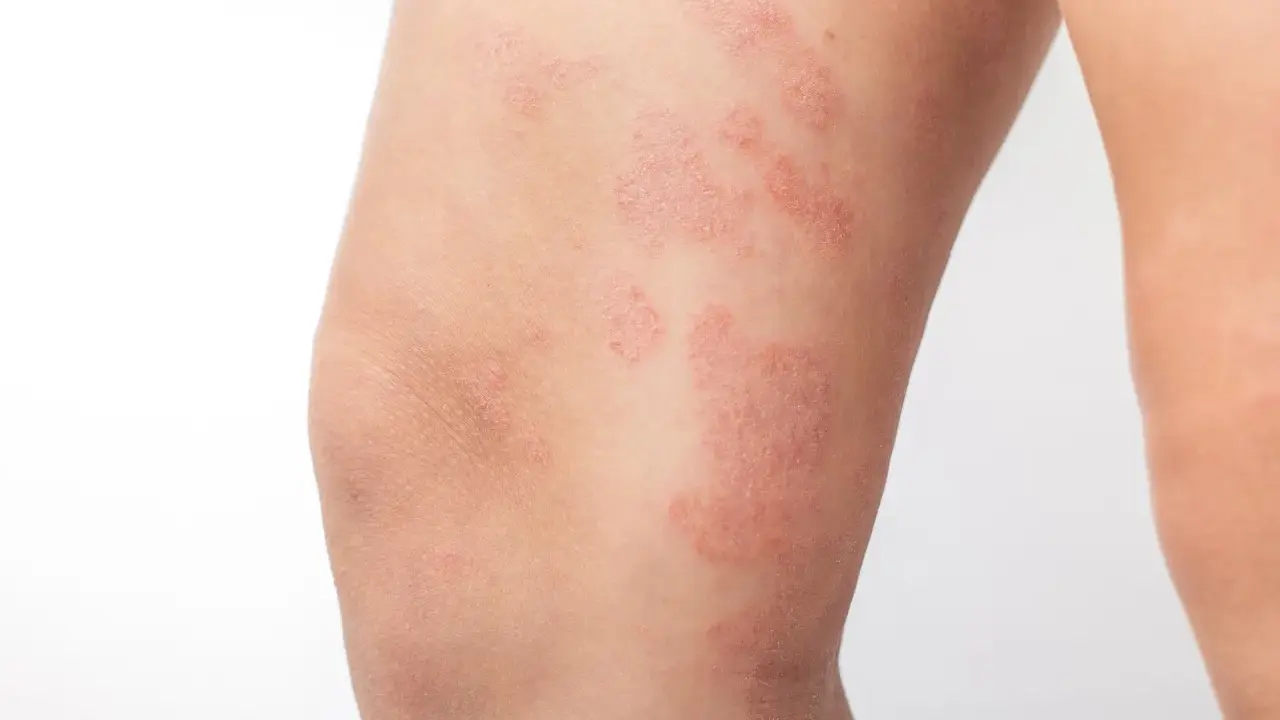 Plaques rouges et squameuses sur la jambe, caractéristiques de l'eczéma nummulaire.