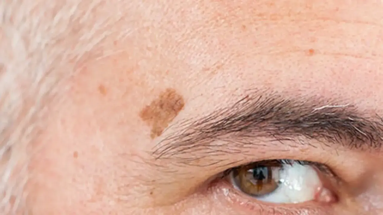 Gros plan sur un œil et un sourcil, avec une tache vieillesse brune sur le front.