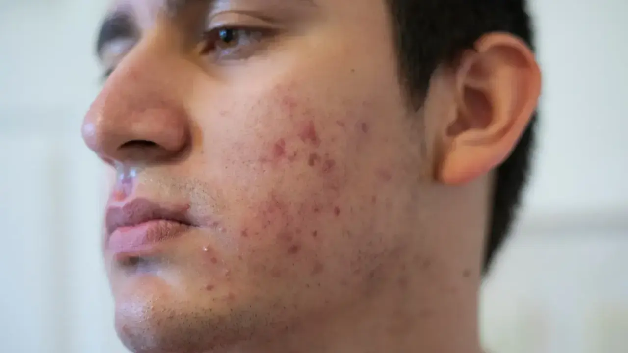 Visage d'un jeune homme avec des rougeurs et des boutons, signes d'acné nodulaire.