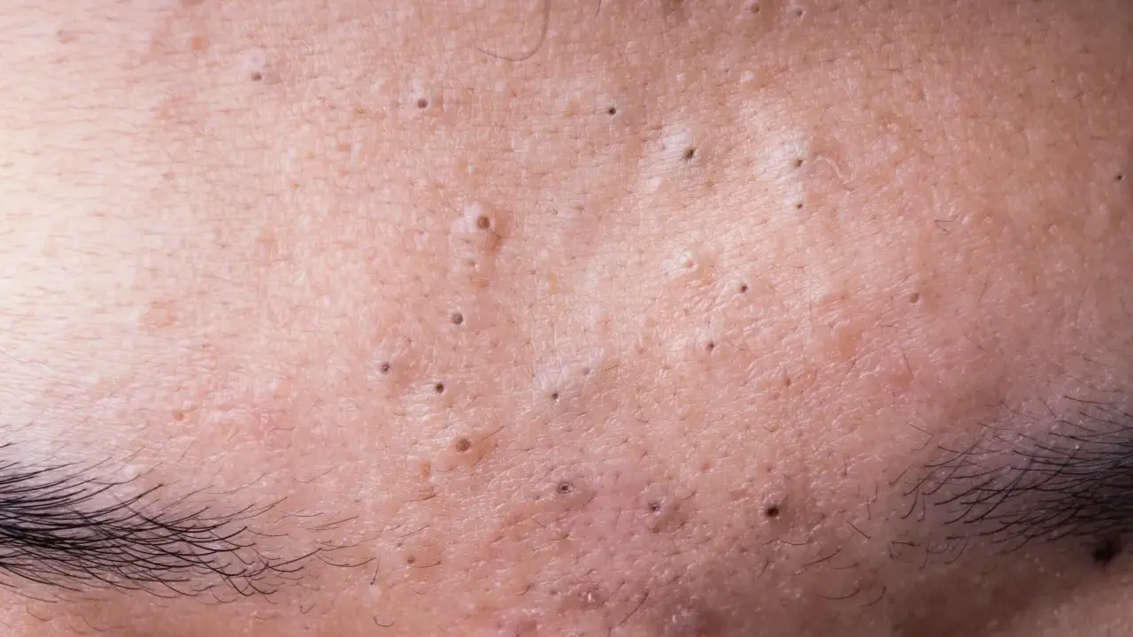 Gros plan sur la peau du front, révélant de minuscules boutons et des pores dilatés, avec des sourcils foncés en bas.