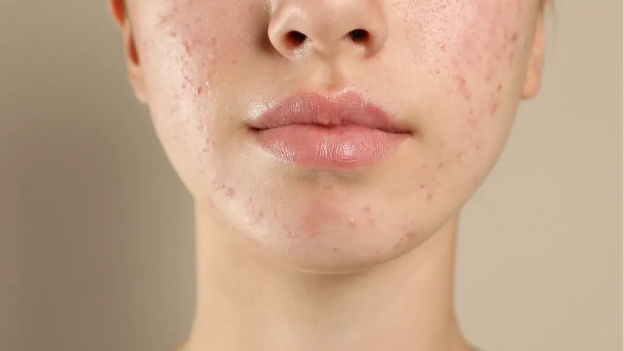 Visage d'une jeune femme avec une peau à tendance acnéique. L'acide salicylique fait ressortir les boutons, révélant une peau en cours de traitement.