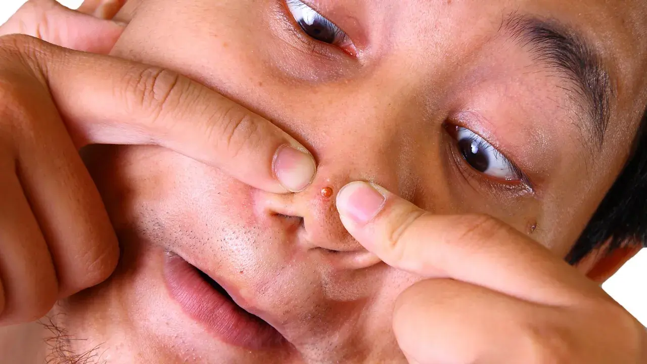 Doigts pinçant un gros bouton noir sur la peau du nez, gros plan sur le visage.
