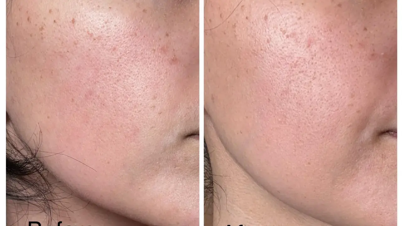 Avant/après : peau avec rougeurs et taches, avant utilisation d'acide azélaïque. Après, la peau est plus lisse, sans danger apparent.