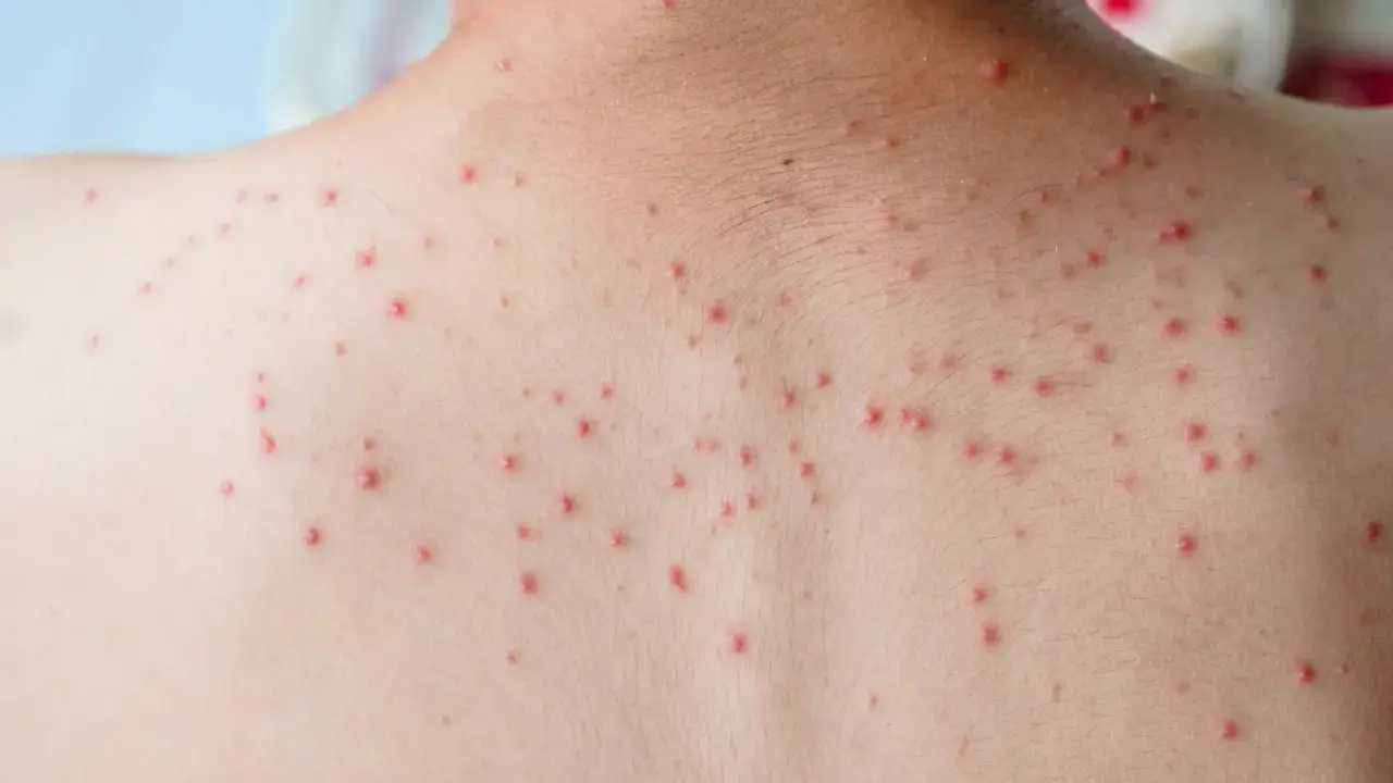 Vue rapprochée du dos d'une personne couverte de petits boutons rouges, possiblement dus à une infection virale comme la varicelle.
