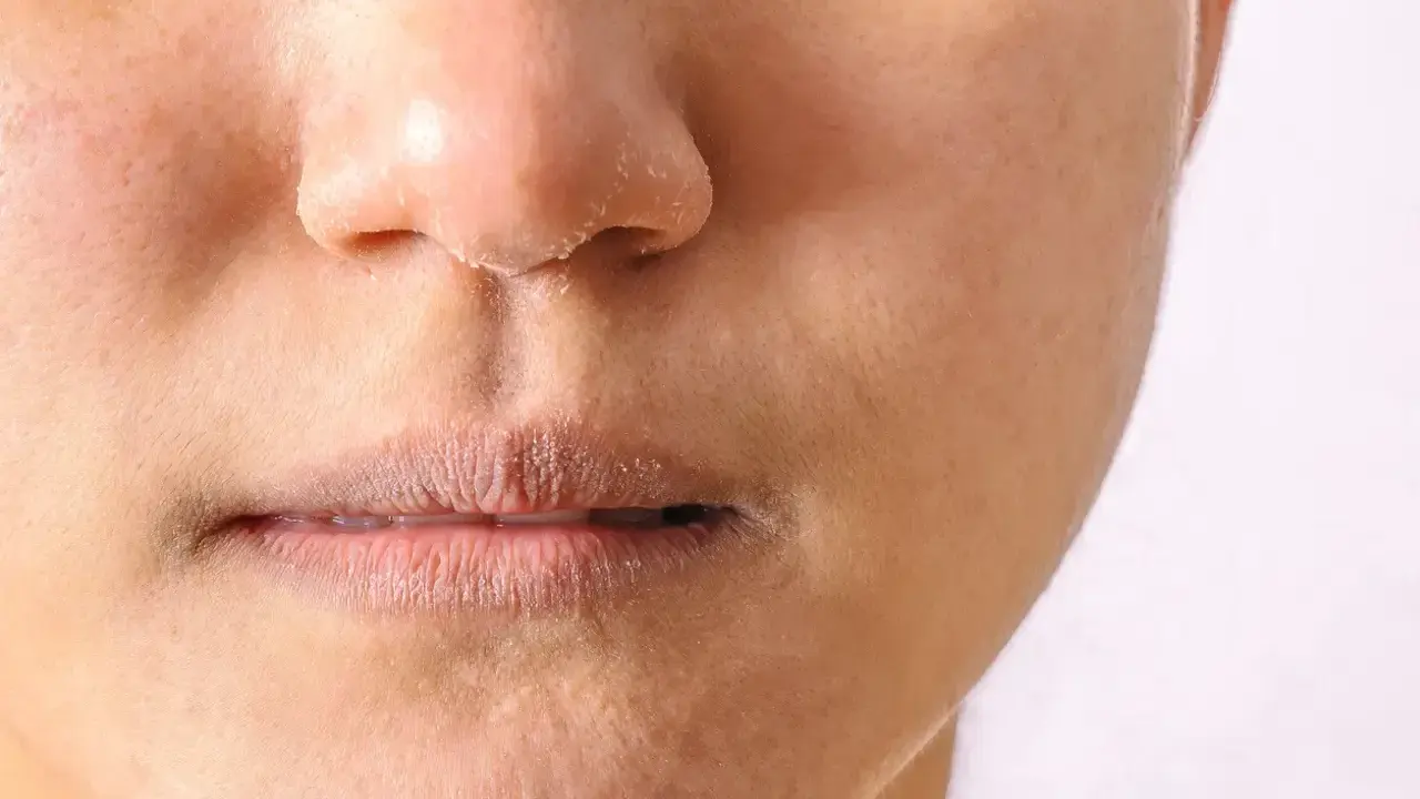 Peau sèche et squameuse autour du nez et des lèvres, signe d'un manque de sébum.