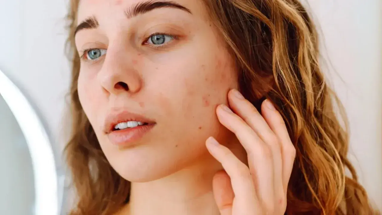 Jeune femme examinant son visage dans un miroir, avec des rougeurs et des imperfections. Comment savoir notre type de peau pour mieux en prendre soin.
