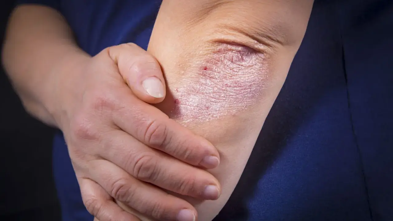 Une personne touche son coude, révélant une plaque de psoriasis inversé, rouge et squameuse, sur sa peau.