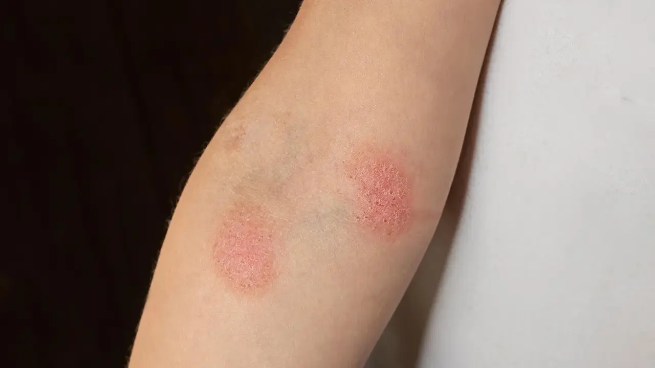 Deux plaques rouges sur un bras, ressemblant à un bouton rouge avec point blanc, indiquent une irritation cutanée.