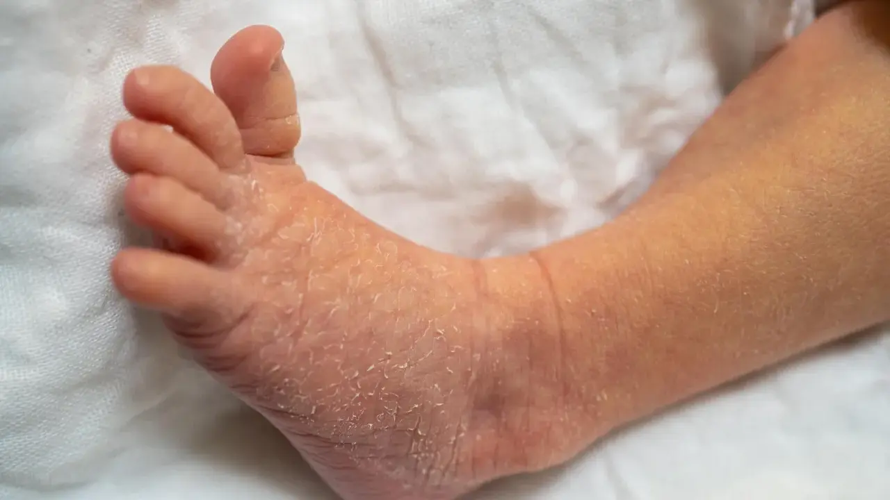 Pied de bébé avec peau sèche et squameuse, évoquant le psoriasis bébé.
