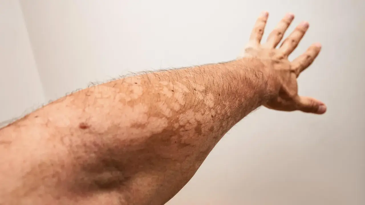 Bras tendu révélant des taches claires dues à un vitiligo léger.