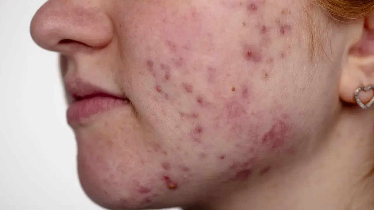 Gros plan sur le visage d'une jeune femme, montrant une peau rougie avec de nombreux comédons et boutons d'acné.