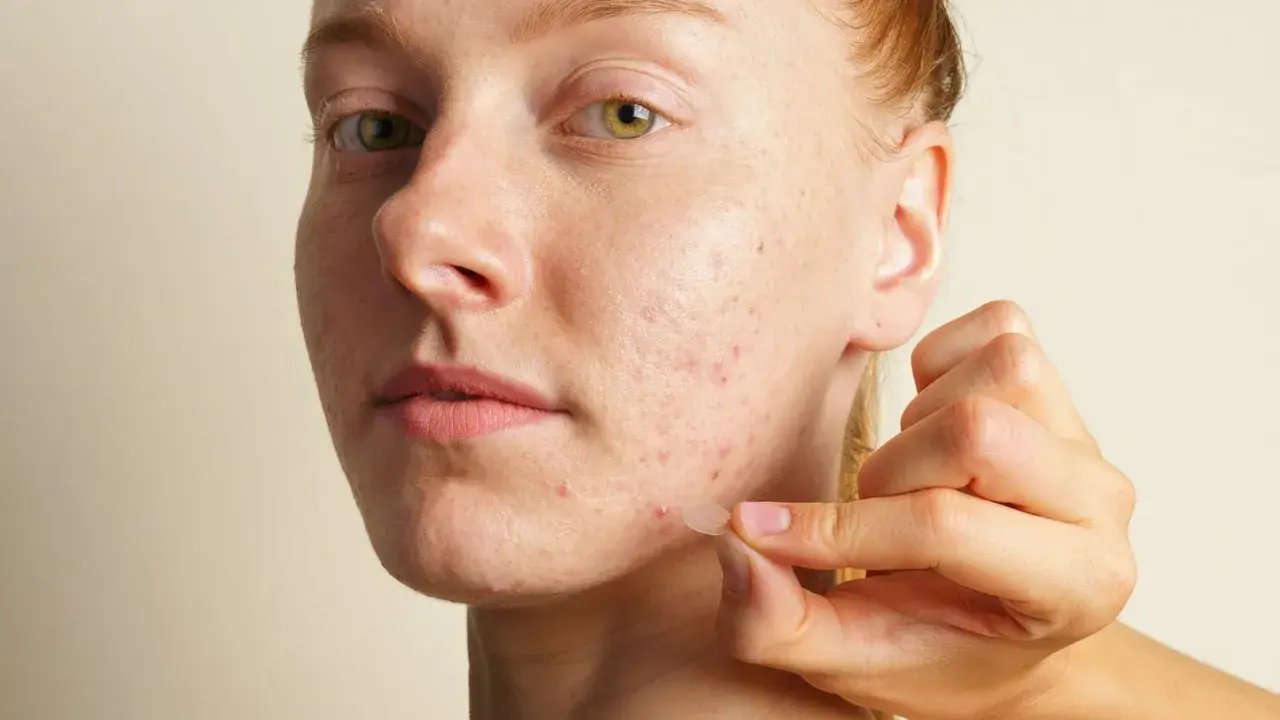 Une main applique un petit pansement transparent sur un bouton d'acné sur le visage d'une jeune femme rousse.