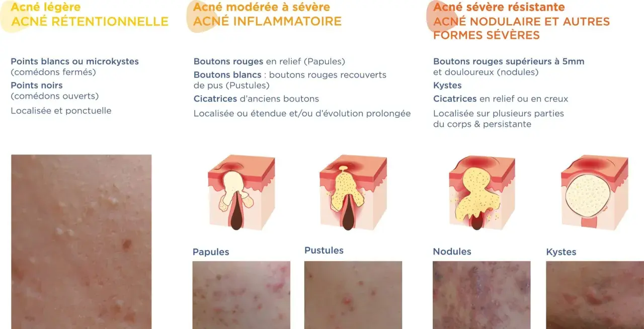 Illustration des différents types d'acné : rétentionnelle, inflammatoire, nodulaire et kystique. Chaque type d'acné est décrit avec ses caractéristiques et représenté par des schémas et des photos.