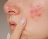 Gros plan sur une joue avec un bouton d'eczéma rouge et irrité, une personne touche délicatement la zone affectée.