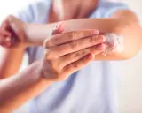 Application d'une crème apaisante sur le coude, une solution pour l'eczéma traitement naturel.