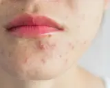 Gros plan sur le bas du visage d'une personne, montrant des imperfections et un bouton sans pu près de la bouche.
